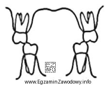 Którą wadę zgryzu przedstawia rysunek?